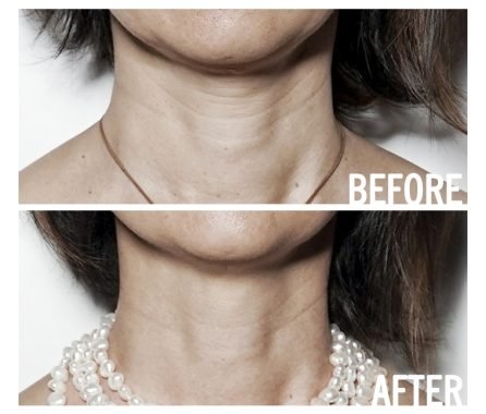 energetic-facelift-gallery-3